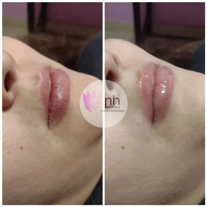 Hidralips/bblips